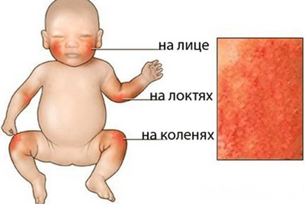 Средства для купания новорожденных, малышей с сухой кожей, детей с атопическим дерматитом