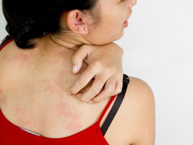 Сыпь на коже, сопровождающаяся зудом и болевыми ощущениями: о чем говорит симптом, как дерматологи диагностируют болезнь