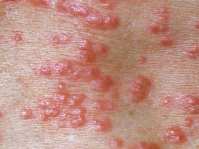 Сыпь на коже, сопровождающаяся зудом и болевыми ощущениями: о чем говорит симптом, как дерматологи диагностируют болезнь