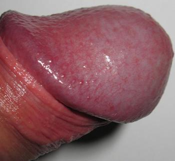 Сыпь на половых органах: члене и на половых губах, почему появилась, как диагностируются разные виды