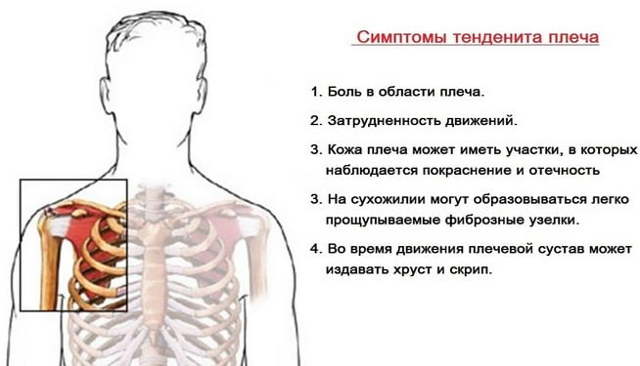 Тендиниты мышц и суставов: причины воспалений, сопутствующие симптомы, диагностика и методы лечения