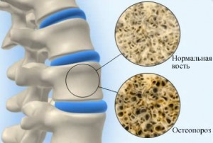 Терапевтические методы лечения остеопороза и лечение народными средствами, симптомы и причины заболевания