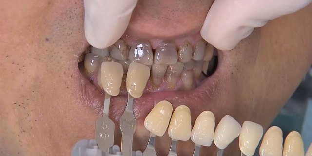 Тетрациклиновые зубы: общее понимание сути проблемы, методы лечения и отбеливания