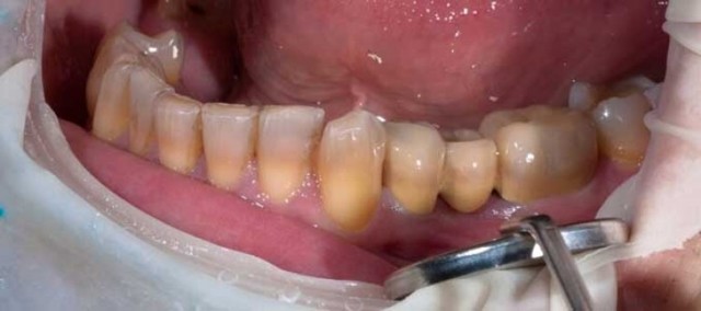 Тетрациклиновые зубы: общее понимание сути проблемы, методы лечения и отбеливания