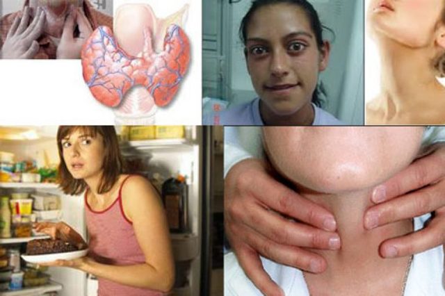 Тиреотоксикоз щитовидной железы: причины возникновения, характерные симптомы, диагностика и тактика лечения