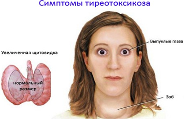 Тиреотоксикоз щитовидной железы: причины возникновения, характерные симптомы, диагностика и тактика лечения