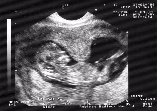 Тонус матки при беременности: почему возникает в 1, 2 и 3 триместрах и что с этим делать?