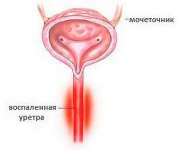 Травма мочеиспускательного канала (уретры) у мужчин и женщин: как проявляется?