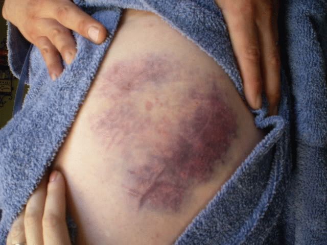 Травмы бедра и тазобедренного сустава: первая помощь и восстановление после травм тазобедренного сустава и берда