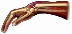 Травмы кисти и лучезапястного сустава: виды повреждений, техника наложения повязки, показания для фиксации