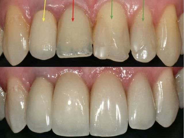 Трещины на зубах: причины появления и виды, способы лечения и профилактики