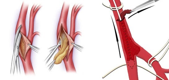 Тромбоэмболия легочной артерии: как диагностируется, причина и какие могут быть осложнения