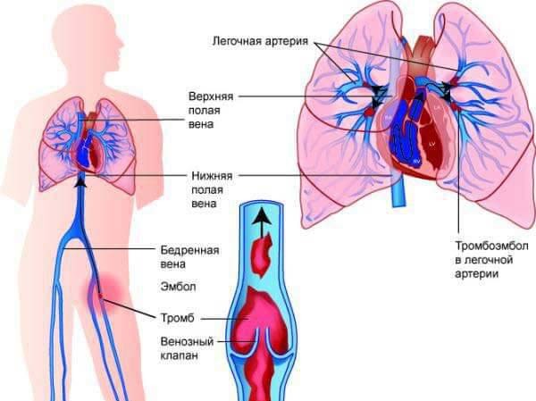 Тромбоэмболия легочной артерии: как диагностируется, причина и какие могут быть осложнения