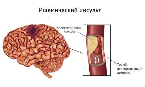 Тромбоэмболия сосудов головного мозга: причины развития, характерные признаки, методы терапии и меры профилактики