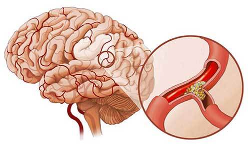 Тромбоэмболия сосудов головного мозга: причины развития, характерные признаки, методы терапии и меры профилактики
