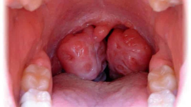 Туберкулез гортани: причины возникновения, как проявляется болезнь, диагностика и методы лечения