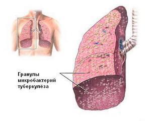 Туберкулез: как проявляется, признаки и профилактика