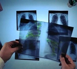 Туберкулез костей и суставов: причины развития, первые признаки, диагностика и лечебный процесс