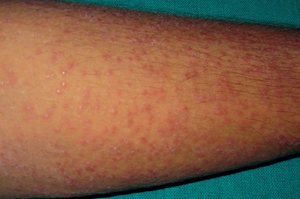 Туберкулез кожи: причины возникновения, симптомы начальной стадии, методы терапии и возможные осложнения