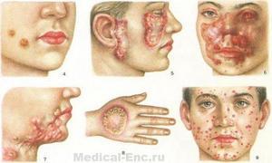 Туберкулез кожи: причины возникновения, симптомы начальной стадии, методы терапии и возможные осложнения