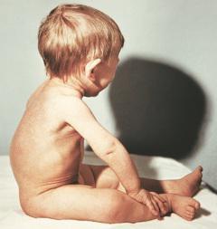 Туберкулез при беременности: причины возникновения, клинические признаки, способы лечения, последствия для ребенка