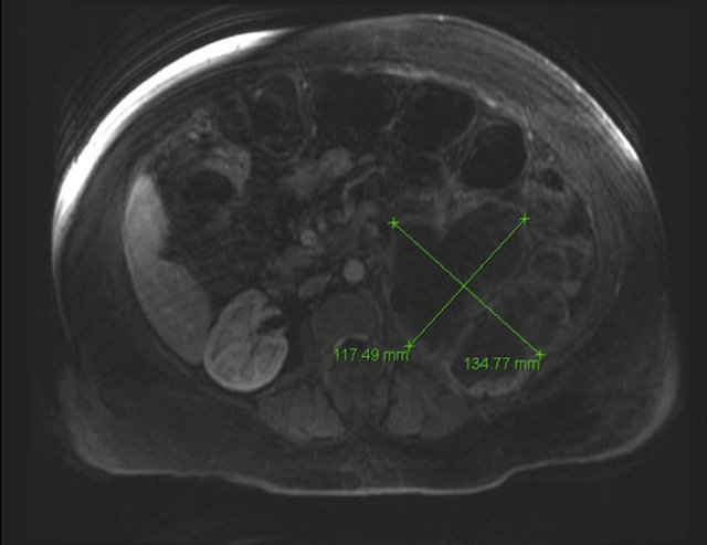 Тубулярный рак почки: клиническая картина, диагностика и тактика лечения, срок жизни