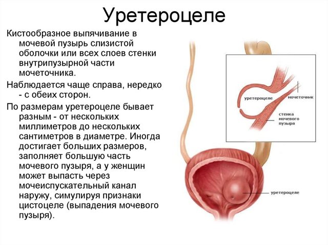 Уретероцеле мочевого пузыря: формы заболевания, характерные симптомы и лечение у взрослых и детей