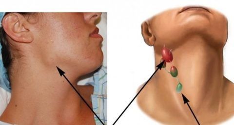 Увеличение, воспаление лимфоузлов на шее, под челюстью: частые причины и методы лечения