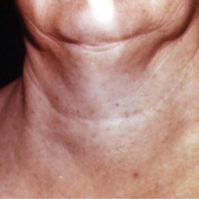 Узловой зоб щитовидной железы — симптомы и лечение, диагностика зоба