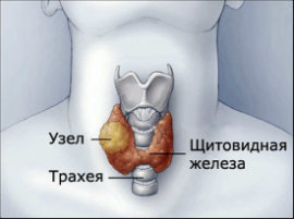 Узловой зоб щитовидной железы — симптомы и лечение, диагностика зоба