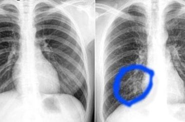 Видно ли на рентгене воспаление легких: как расшифровать снимок ребенка