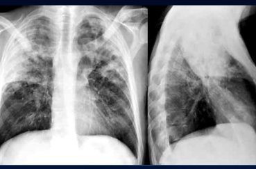 Видно ли на рентгене воспаление легких: как расшифровать снимок ребенка