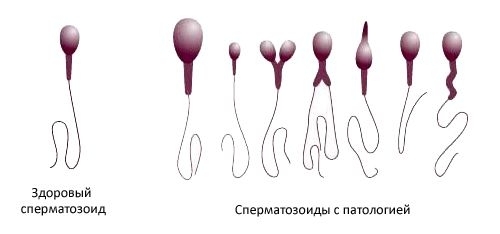 Виды патологий спермы и лечение мужского бесплодия: новые методики и возможности репродуктивной медицины 