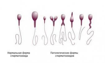 Виды патологий спермы и лечение мужского бесплодия: новые методики и возможности репродуктивной медицины 
