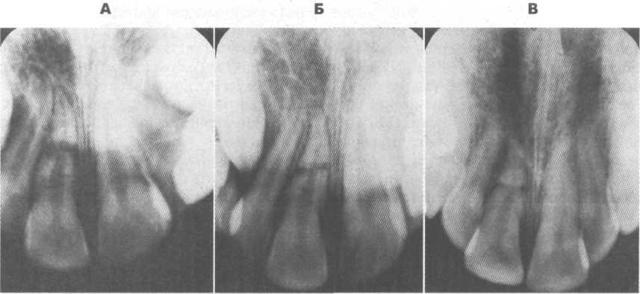 Вколоченный, полный и неполный вывих зубов: причины травм, характерные признаки, лечение и возможные осложнения