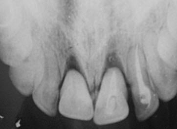 Вколоченный, полный и неполный вывих зубов: причины травм, характерные признаки, лечение и возможные осложнения
