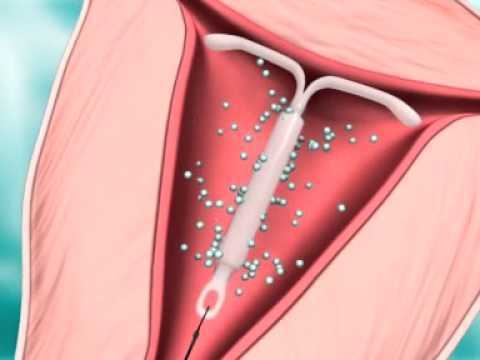 Внутриматочная контрацепция: плюсы и минусы метода, классификация спиралей, возможные последствия