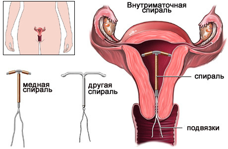 Внутриматочная контрацепция: плюсы и минусы метода, классификация спиралей, возможные последствия