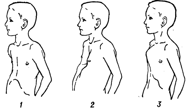 Воронкообразная грудная клетка у ребенка: причины и степени деформации, клиническая картина, способы лечения