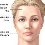 Воспаление лицевого нерва: симптомы и препараты для лечения в домашних условиях