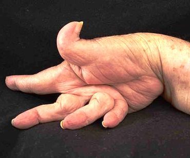 Воспаление суставов пальцев рук и ног: основные причины, типичные симптомы, методы терапии и профилактика