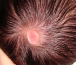 Врожденная аплазия кожи волосистой части головы у новорожденных: причины развития, сопутствующие симптомы, методы лечения