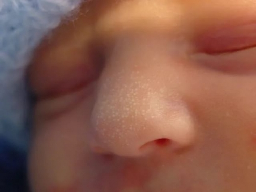Врожденная аплазия кожи волосистой части головы у новорожденных: причины развития, сопутствующие симптомы, методы лечения