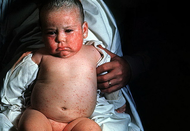 Врожденная цитомегаловирусная инфекция у новорожденных: пути заражения, характерные признаки, лечение и профилактика развития осложнений