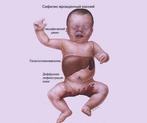 Врожденный сифилис: вероятность заражения, клиническая картина, диагностика и особенности лечения