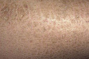 Вульгарный ихтиоз кожи: причины появления и симптомы патологии, методики лечения, возможные осложнения