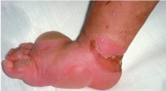 Вульгарный ихтиоз кожи: причины появления и симптомы патологии, методики лечения, возможные осложнения