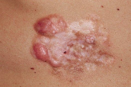 Выбухающая дерматофибросаркома кожи: факторы развития опухоли, типичные симптомы, методики лечения и прогноз