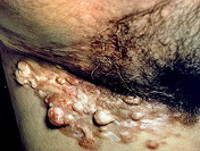 Выбухающая дерматофибросаркома кожи: факторы развития опухоли, типичные симптомы, методики лечения и прогноз