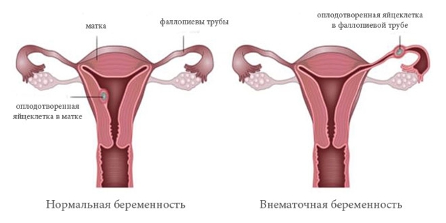 Выделения при беременности: провоцирующие факторы, классификация и характерные признаки, методы обследования и лечения